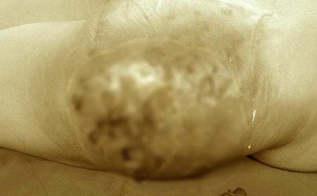 Vòng 3 biến dạng, hoại tử nghiêm trọng sau tiêm silicon-2