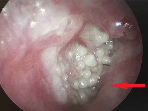 Sùi mào gà mọc trong lỗ tai vì thường xuyên ngoáy tai ngoài tiệm