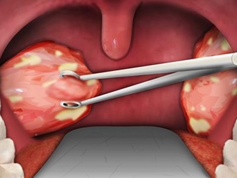 Bé gái 7 tuổi tử vong chỉ sau vài phút phẫu thuật cắt amidan, chuyên gia đưa ra một loạt cảnh báo-6