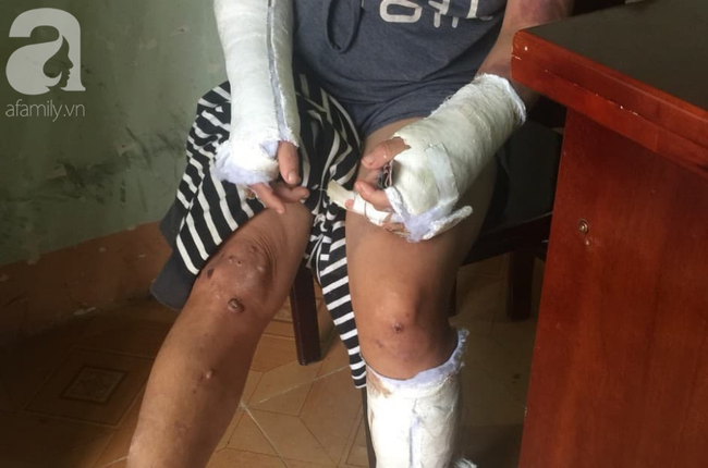 Nghi án vợ đang mang thai 7 tháng bị chồng hành hạ, đánh đập nhiều lần đến hỏng mắt, người chi chít vết thương-3