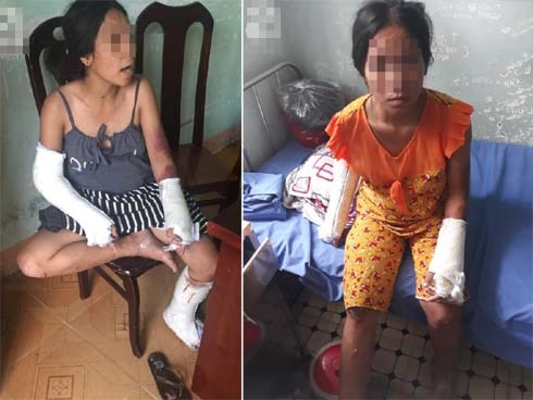 Nghi án vợ đang mang thai 7 tháng bị chồng hành hạ, đánh đập nhiều lần đến hỏng mắt, người chi chít vết thương