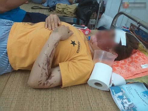 Người phụ nữ kể lại giây phút kinh hoàng khi bị gã đàn ông lao tới tạt axit khiến biến dạng khuôn mặt