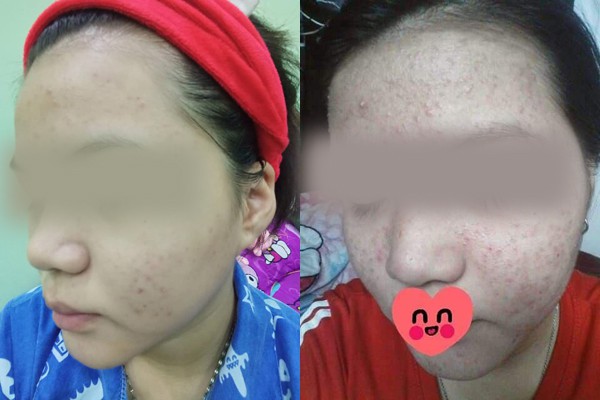 Dùng rượu thuốc bán tràn lan trên mạng để trị mụn, tái tạo da nhiều chị em rước họa nát mặt-2