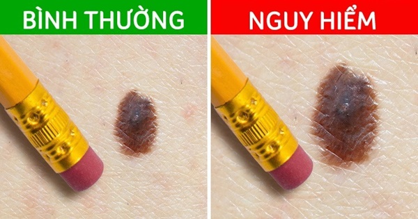 5 tín hiệu từ nốt ruồi cảnh báo ung thư đang tiềm ẩn dưới làn da-4
