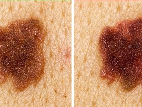 5 tín hiệu từ nốt ruồi cảnh báo ung thư đang tiềm ẩn dưới làn da