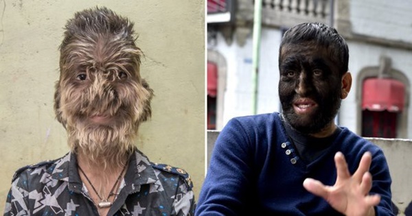 Hàng loạt trẻ em Tây Ban Nha mắc hội chứng người sói vì uống phải thuốc bẩn-1