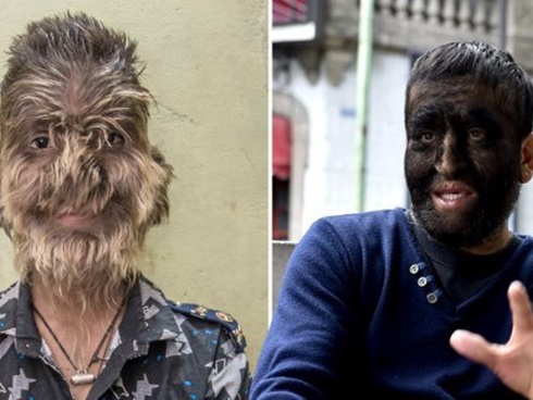 Cô bé người sói với khuôn mặt nhiều lông lá nhất thế giới sau hơn 10 năm xuất hiện trở lại với vẻ ngoài cùng cuộc sống gây kinh ngạc-8