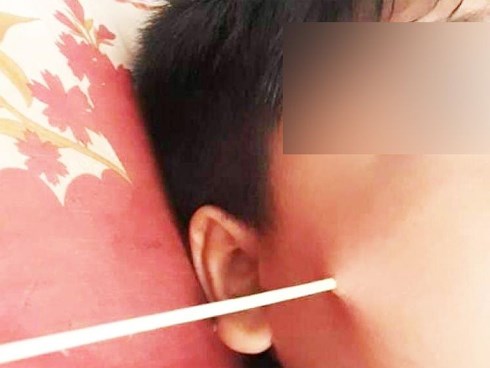 Học sinh bị que đâm thủng mặt ở trường: Cha mẹ đừng chỉ lo sợ suông, hãy can thiệp ngay các vấn đề sau