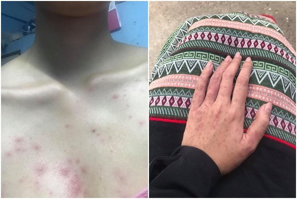 Người phụ nữ nổi phát ban kín khắp người vì thói quen suốt 3 tháng ai cũng cần phải tránh-1