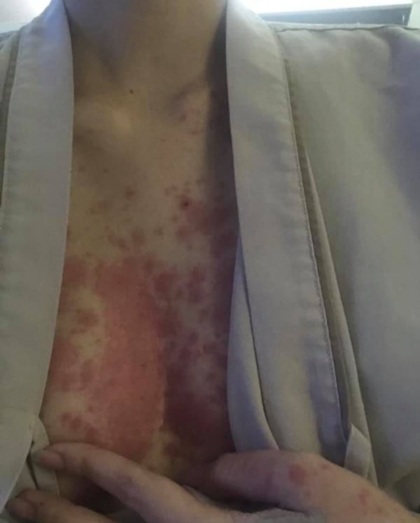 Người phụ nữ nổi phát ban kín khắp người vì thói quen suốt 3 tháng ai cũng cần phải tránh-2