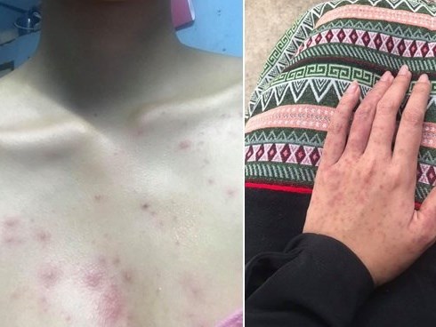 Người phụ nữ nổi phát ban kín khắp người vì thói quen suốt 3 tháng ai cũng cần phải tránh