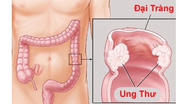 Bác sĩ cảnh báo: Bị đau bụng âm ỉ, có thể bạn đã bị ung thư nhưng không hề biết-2