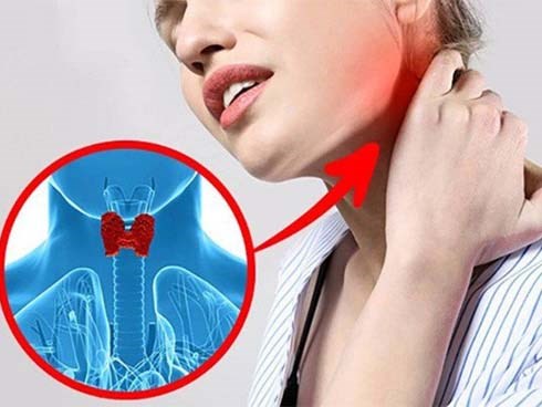 Căn bệnh ở cổ, chị em mắc nhiều hơn nam giới: Rụng tóc, giảm ham muốn hãy coi chừng