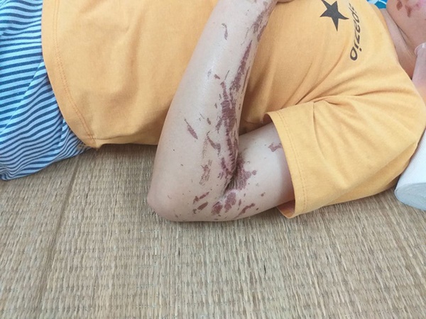 Xác định kẻ chủ mưa vụ nữ nhân viên trạm dừng nghỉ bị kẻ lạ mặt hất thẳng cốc axit vào mặt-1