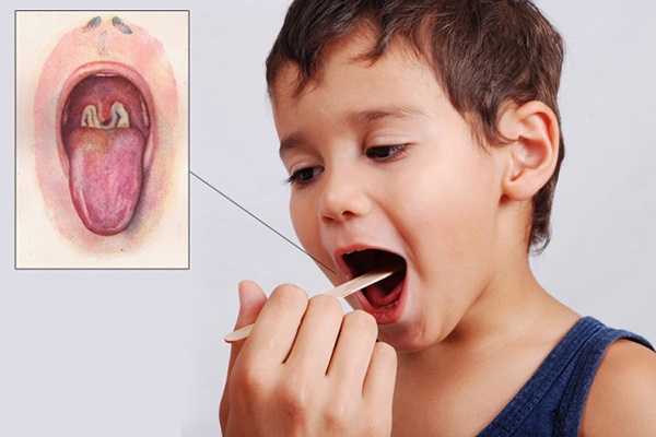 Những điều cần biết về bạch hầu - căn bệnh có thể gây tử vong trong 6 ngày-2