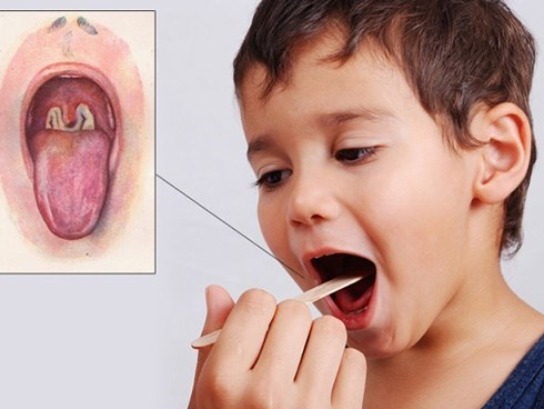 Những điều cần biết về bạch hầu - căn bệnh có thể gây tử vong trong 6 ngày