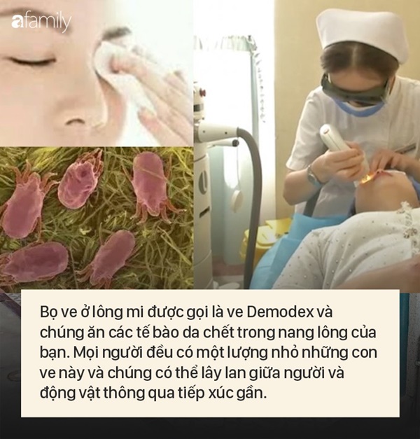 Bài học cho chị em thích trang điểm: Vô số bọ ve làm tổ ở lông mi người phụ nữ 32 tuổi vì không tẩy trang cuối ngày-3