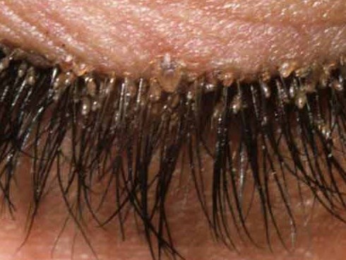 Bài học cho chị em thích trang điểm: Vô số bọ ve