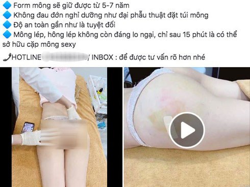 Rộ quảng cáo tiêm mông bằng filler tại Việt Nam, mỗi lần tiêm tới 100 - 200cc vẫn khiến chị em đổ xô đi làm