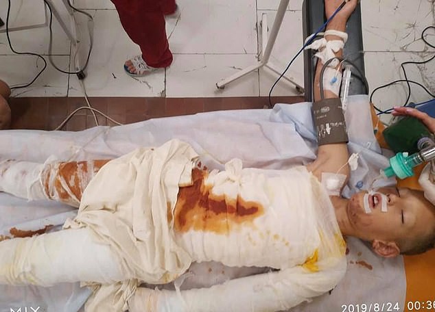 Đang chơi ở sân chung cư, cậu bé 8 tuổi bất ngờ bị một đám trẻ tưới xăng lên người và thiêu sống-1