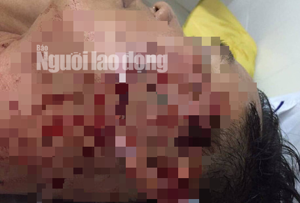 Đại úy công an bị đánh trọng thương do đối tượng vi phạm giao thông ôm hận”-3