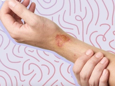 Người phụ nữ này bị sốc nhiễm độc kéo dài nhiều năm đến nỗi phải cắt ngón tay, ngón chân, nguyên nhân chỉ từ một cú ngã