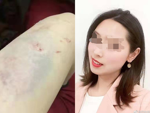 Sống với mẹ nhưng tối nào cũng phải sang cho bố chăm sóc, bé gái hơn 1 tuổi bất ngờ nhập viện trong tình trạng toàn thân tổn thương nghiêm trọng-4