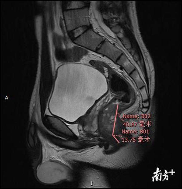 17 tuổi mắc ung thư trực tràng, bác sĩ nói thực hiện 4 thói quen này trước khi muộn-1