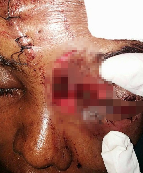 Người phụ nữ bị mù mắt vì sai lầm thường gặp ở các bà nội trợ khi dùng nồi áp suất trên bếp gas-1