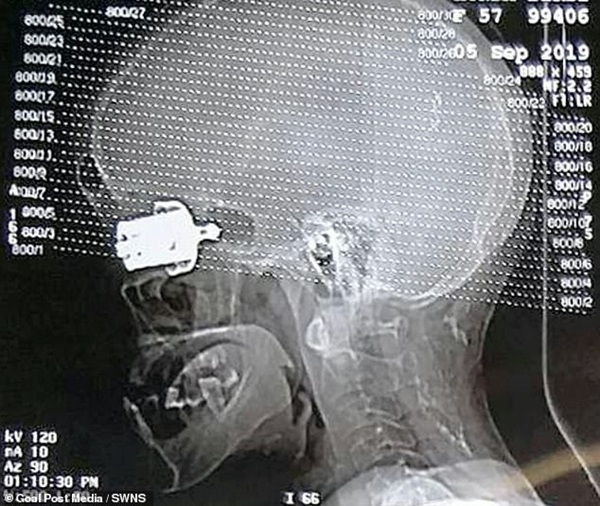 Người phụ nữ bị mù mắt vì sai lầm thường gặp ở các bà nội trợ khi dùng nồi áp suất trên bếp gas-2