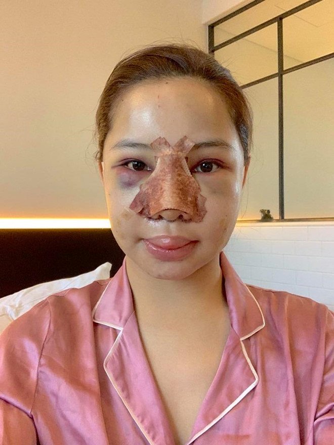 Lưu Đê Ly công khai phẫu thuật thẩm mỹ toàn bộ gương mặt-1