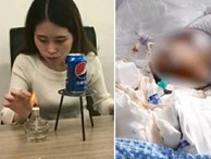 Bắt chước 'thánh nữ văn phòng' Tiểu Dã làm bỏng ngô tại nhà, bé gái 14 tuổi gặp tai nạn bỏng nặng rồi tử vong sau hơn 1 tuần
