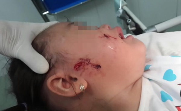 Whitmore - căn bệnh gây ra bởi vi khuẩn ăn thịt người tưởng đã bị lãng quên ở Việt Nam nhưng vừa khiến 4 người tử vong thực sự nguy hiểm thế nào?-3