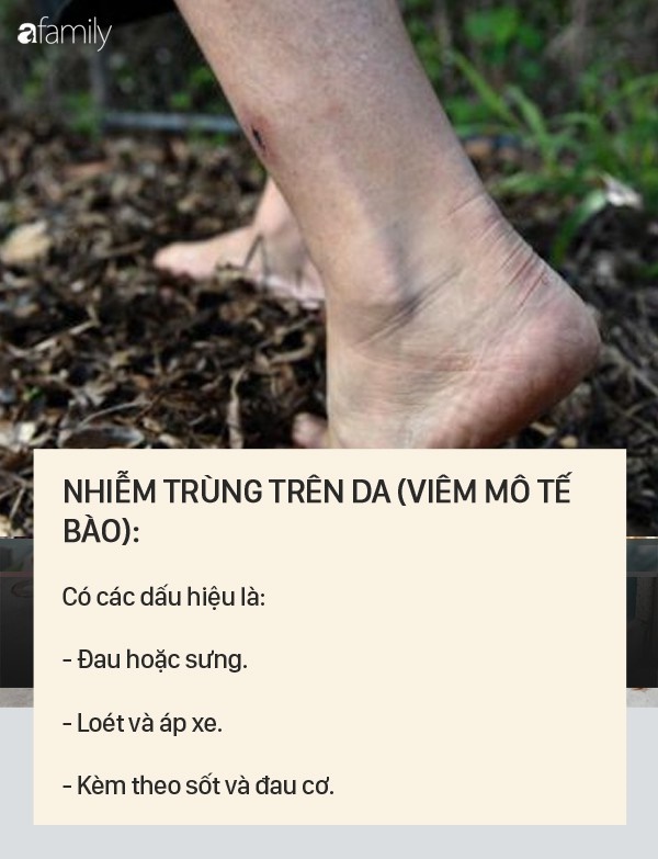 Dấu hiệu bệnh whitmore - căn bệnh do vi khuẩn ăn mòn cơ thể con người, có thể gây tử vong trong vài ngày-4