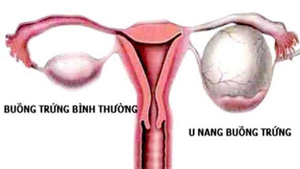 Tưởng con gái đau bụng do rối loạn tiêu hóa, mẹ bất ngờ khi biết sự thật-1