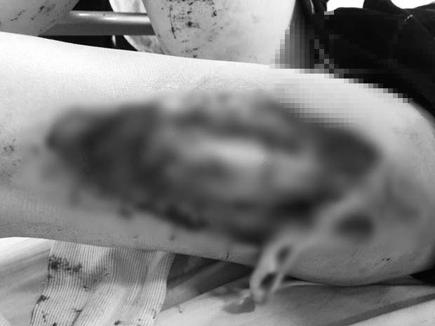 Bác sĩ Bệnh viện Xanh Pôn thông tin vụ nữ CĐV bị pháo bắn trúng: Vết thương do công phá từ sức nổ, không phải do bỏng-3
