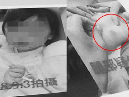 Sống với mẹ nhưng tối nào cũng phải sang cho bố chăm sóc, bé gái hơn 1 tuổi bất ngờ nhập viện trong tình trạng toàn thân tổn thương nghiêm trọng