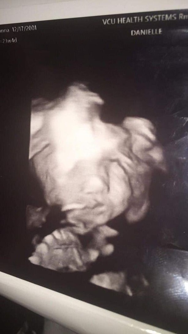 Đi siêu âm thai nhi 24 tuần tuổi, bà mẹ hết hồn khi thấy hình ảnh bé con như đang nhìn chằm chằm mình-2