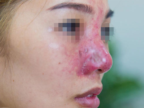 Rùng rợn những hình ảnh nâng chân mày, nâng mũi sởn gai ốc, người phụ nữ sau phẫu thuật đưa ra lời khuyên chân thành đến chị em ham làm đẹp-7