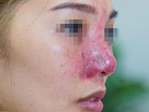 Cô gái suýt mất mũi vì tiêm filler giá rẻ ở spa