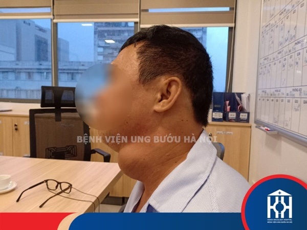 Mặt lệch hẳn sang một bên với khối hạch có kích thước lên đến 7cm của bệnh nhân ung thư tuyến giáp-1
