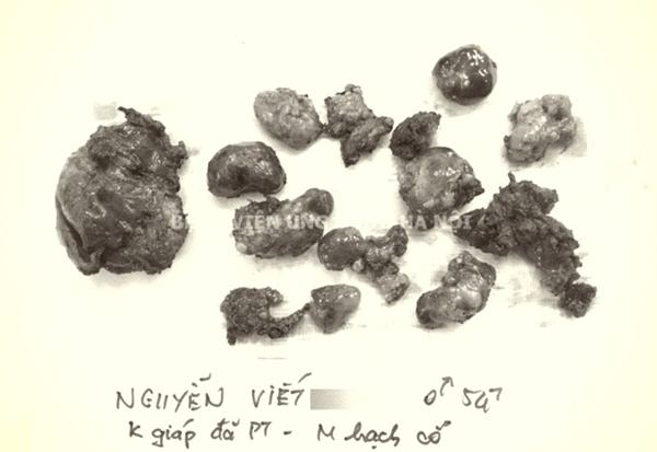 Mặt lệch hẳn sang một bên với khối hạch có kích thước lên đến 7cm của bệnh nhân ung thư tuyến giáp-2