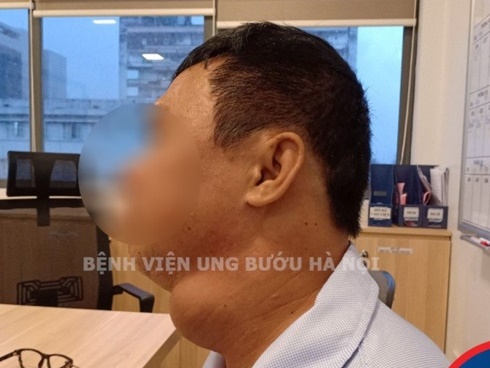 Người phụ nữ dễ bị sặc khi ăn uống, khàn tiếng kéo dài 3 tháng, đi khám mới biết mình mắc bệnh ung thư-3