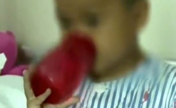 Con trai 5 tuổi có dấu hiệu run tay, mẹ sốc khi bác sĩ lấy ra khối u có đủ răng lẫn tóc trong não bé-1