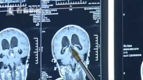 Con trai 5 tuổi có dấu hiệu run tay, mẹ sốc khi bác sĩ lấy ra khối u có đủ răng lẫn tóc trong não bé-2