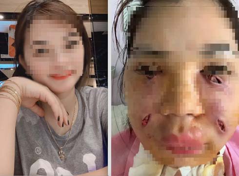 Cận cảnh dùng ống hút mỡ xiên bụng khách bị bóc phốt như chọc tiết lợn: Bác sĩ chuyên khoa cũng phải thảng thốt hút mỡ bụng đáng sợ như vậy sao?-6