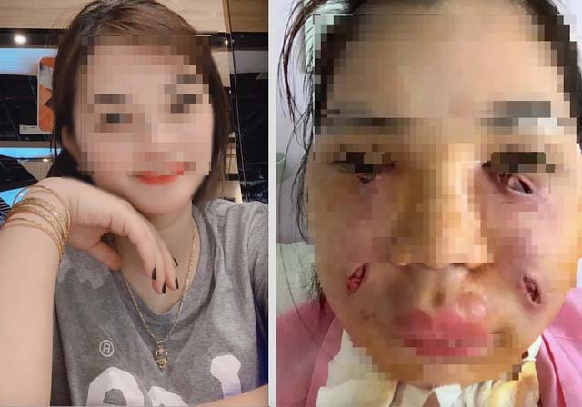 Hút mỡ làm đẹp: Tham một lần chơi lớn combo, gánh không nổi hậu họa-1