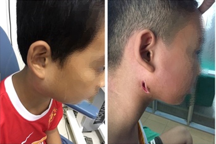 Một bệnh viện ở Nghệ An công bố 3 trẻ nhiễm bệnh Whitmore ăn thịt người: Cảnh báo dấu hiệu dễ nhầm lẫn với bệnh quai bị-1