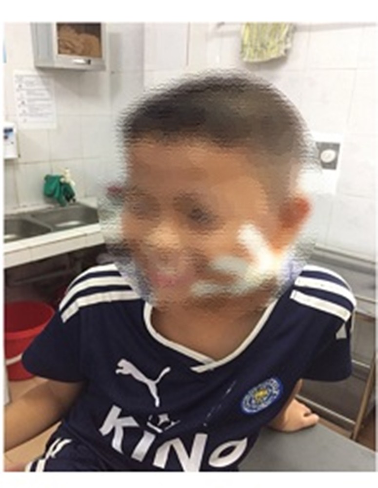 Một bệnh viện ở Nghệ An công bố 3 trẻ nhiễm bệnh Whitmore ăn thịt người: Cảnh báo dấu hiệu dễ nhầm lẫn với bệnh quai bị-2