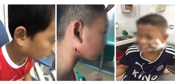 Bệnh Whitmore ăn mòn cơ thể có lây từ người sang người?-1